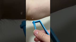 Removing skin tags at home!