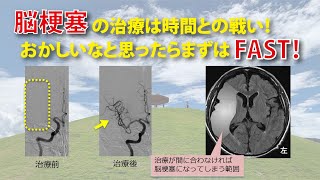 脳梗塞の治療は時間との戦い！おかしいなと思ったらまずはFAST!!