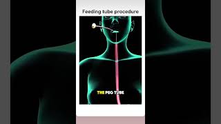 PEG procedure done #mbbs #neet #mbbslife