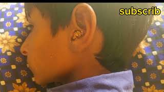 EAR max removal #earcleaning #healthcare #satisfyingvideo #earhygiene#earhygiene