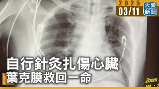 "針"驚險 ! 自行針灸扎傷心臟葉克膜救命｜大愛新聞 @DaaiWorldNews