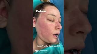 FaceLift & Fat Injection Before & After