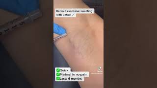 Botox Treatment For Hyperhidrosis!