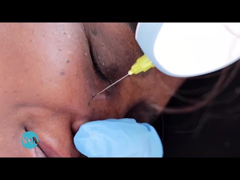 የቆዳ ላይ ቀላል እብጠት መሰል ነገሮች እና የቆዳ ቀለምን የሚለውጡ ምልክቶች ለጤና ያሳስቡ ይኾን?