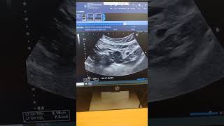 4/28/22 vaginal ultrasound