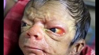 【閲覧注意】世界の奇病・奇形・難病の人々　※刺激が強いです