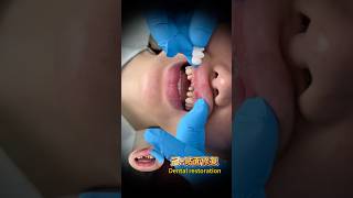 Dental veneer repair #上海医美 #牙齿贴面 #do牙#牙缝大#小白牙