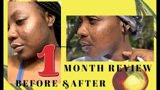 WANT CLEAR SKIN?|| URBANSKINRX 1 MONTH REVIEW|| MUST WATCH!!!|| NO MORE ACNE|| GET RID OF ACNE FAST!