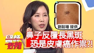 鼻子反覆長黑斑，恐是皮膚癌作祟？！【醫師好辣】20200101 part4 EP872 田知學 林吟蔚