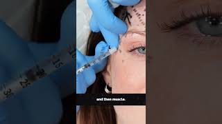 Botox brow lift injection depth