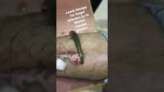 Leech therapy for fungal infection by Dr. Manish chandel gwalior