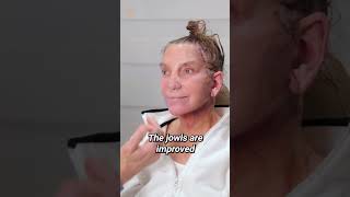 Vertical Facelift Patient 1 Day Post-Op #antiaging #cosmetic #shortfeed #aesthetics #facelift