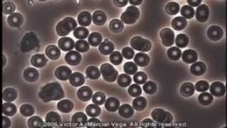 Difference Between Acidic Blood vs Healthy Blood Cells