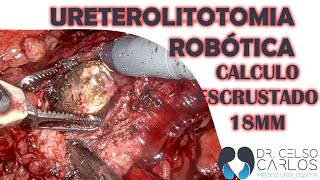 Robotic assisted ureterolithotomy - Proximal large ureter stone - URETEROLITOTOMIA ROBOTICA - BRASIL