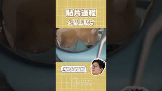 陶瓷貼片怎麼做？製作大公開：1分鐘快速解析｜【祐民牙醫－隱適美旗艦店】許四融醫師 (小許醫師) #陶瓷貼片 #美白牙齒 #祐民牙醫