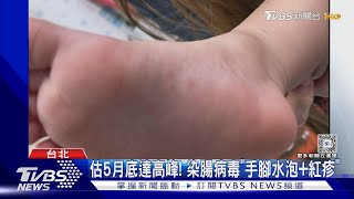 腸病毒10年新高「2嬰重症」 北市已229班停課｜TVBS新聞 @TVBSNEWS01