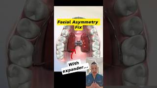 Fixing Facial Asymmetry with a Palate Expander: Here's How! #dentallan #dentist #shorts