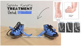 Review : Dennis Brown Splint / Sepatu Koreksi Untuk CTEV