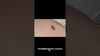 癌症相關視網膜病變有哪些症狀？ #shorts