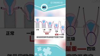 子宮脫垂根據嚴重程度分成四個等級｜醫SICK醫識 #am730 #婦人科 #病症