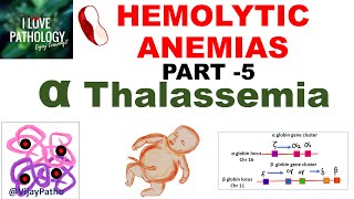 Hemolytic Anemias- Part 5: Alpha Thalassemia- Pathogenesis, types, Diagnosis & Treatment