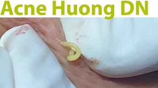 Acne Treatment Huong Da Nang#738 #Hiddenacne
