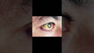 What Your Eyes Say About Your Health - Yellow Whites of Your Eyes