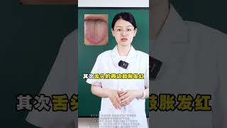 肝郁+脾虚这种裂纹舌，可不能一味吃逍遥丸 #中医 #舌苔 #调理身体 #中医养生