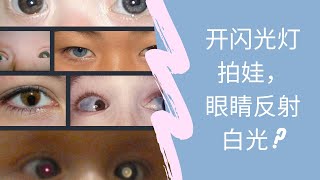 北美儿科/新生儿眼睛检查/两只眼睛颜色不一样