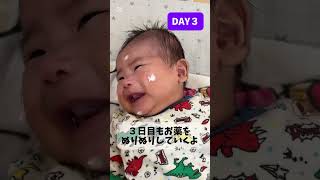 【生後2ヶ月赤ちゃん】　劇的に乳児湿疹が改善　#赤ちゃん #赤ちゃんのいる生活 #生後2ヶ月 #乳児湿疹#薬#ロコイド#湿疹#顔#baby #babyboy #babyshorts #shorts