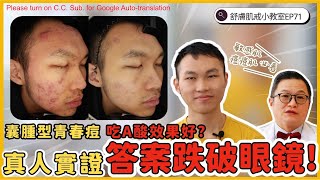 囊腫型青春痘 一定要吃A酸？真人實證　科學證據教你這樣對抗青春痘，最有CP值！【舒膚肌戒小教室EP71】（Multi. Sub.）#肌膚監測　#敏感肌　#痘痘　#水光肌　#A酸　#酒糟肌