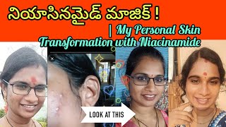 "నియాసినమైడ్ తో నా చర్మ మార్పు" : Before and After" | Skin care in Telugu #skincare #niacinamide