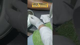Ayurvedic Leech therapy in Varicose Vein patient 😷🤓#shorts#shortsvideo#leechtherapy#ayurveda