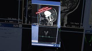 Mri csf flow Study #mri csf flow cerebral aqueduct