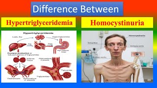 Difference between Hypertriglyceridemia and Homocystinuria