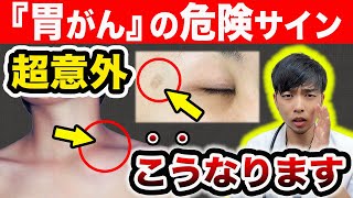 【放置危険】その皮膚の変化『胃がん』のサインです。知らないと後悔する、５つの病変。【現役医師が意外な症状と発がんリスクをアニメ解説】ピロリ菌は〇〇してください…