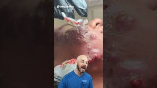 Reacting to SEVERE cystic acne (credit:@theacnelab on TT) #skincare #foryoupage #doctor #satisfying