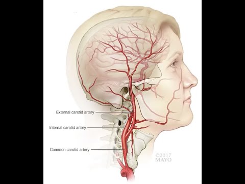 MRI Imaging of Intracranial Arteries