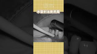 牙周病怎麼治療？水雷射原來是好選擇！｜【祐民牙醫－隱適美旗艦店】鑽石級楊大為醫師#祐民牙醫 #水雷射 #牙周病