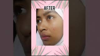 Customer feedback! #skintransformation #nomoreacne #reduceacnescars #shorts #nihonskin