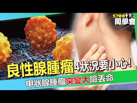 「良性腺腫瘤」4狀況要小心！45歲男「甲狀腺腫瘤」突變大15公分！？「腫瘤大出血」險丟命！【 @57healthy 】#田知學 醫師