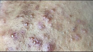 Blackhead removal,080, whitehead,pimple,acne,#blackheads , #acne ,#pimple ,#acnetreatment ,#asmr,#