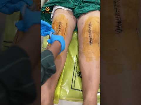 What Your Knee Replacement Dressing SHOULD Look Like at 2 Weeks Post-Op? | Orthoderm Guwahati