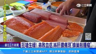 狂嗑生蠔！弟敗血症、姊肝膿瘍現「蜂巢般腫瘤」｜三立新聞網 SETN.com