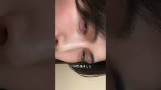 ビフォーアフター #ビフォーアフター #美容 #整形男子 #整形 #美容医療
