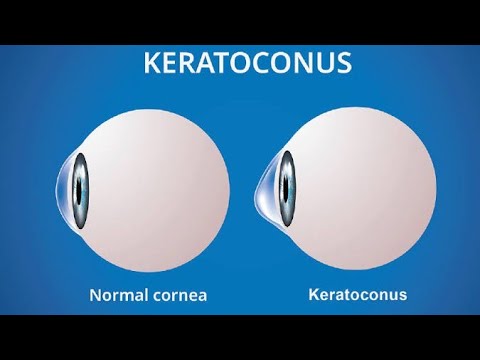 No Surgical Management of Keratoconus। Treatment Of keratoconus with Scleral lens। Dr Mantu Akon।