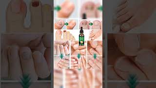 7-Day Ginger Nail Growth & Strengthener | Ultimate Nail Care & Cuticle Treatment