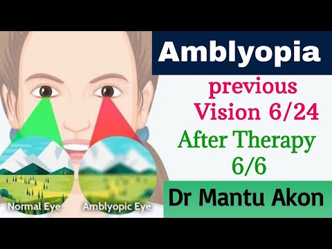 Amblyopia (lazy eye) Treatment।Previous vision 6/24 after vision Therapy 6/6 without patching।