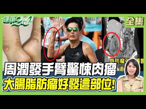 周潤發慢跑大腿2腫包 手臂見肉瘤！ 5種唇色看脾胃 中醫1茶飲疏肝散結！【健康2.0 完整版】 #陳欣湄 #錢政弘 #柳朋馳 #吳明珠 #陳麗華 #潘瑋翔 @tvbschannel