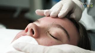 Treatment with Revitalize Pure and Revitalize Vitamins - Active acne